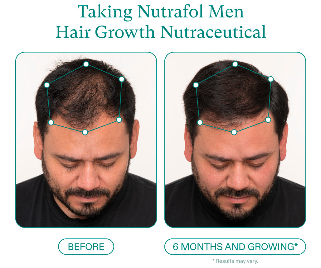 Nutrafol Men Before and after 6 months growing. Taking Nutrafol Men Hair Growth Nutraceutical