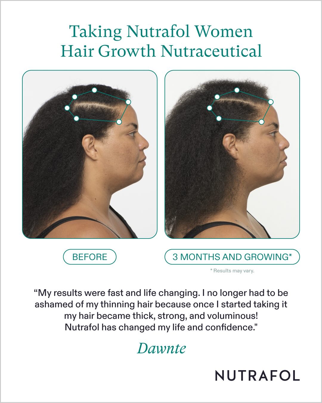 Before and after taking nutrafol women hair growth nutraceutical. 3 months and growing