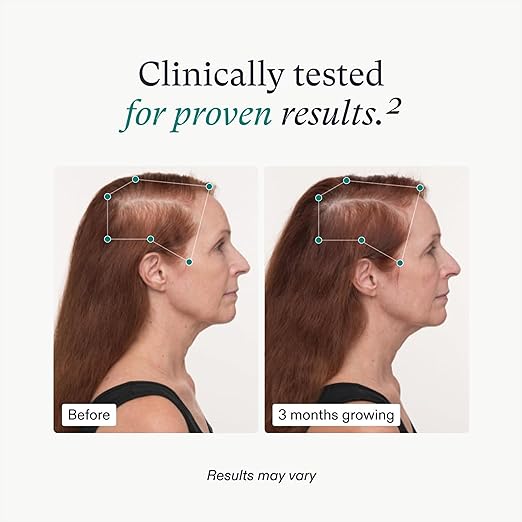 nutrafol womens balance before and after results