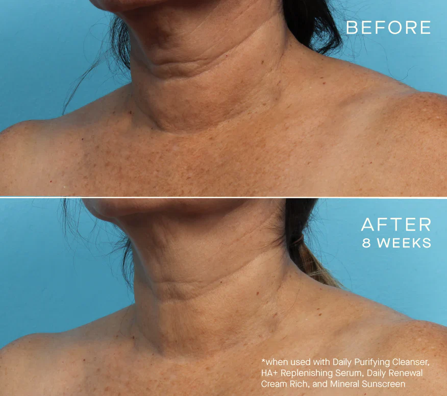 HA REplenishing serum Before and after