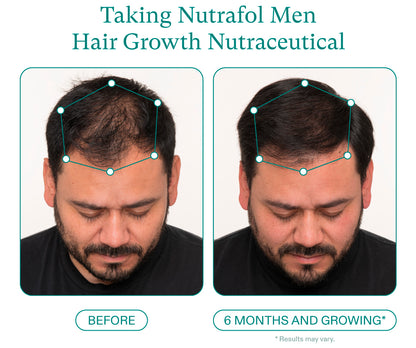 Nutrafol Men Before and after 6 months growing. Taking Nutrafol Men Hair Growth Nutraceutical