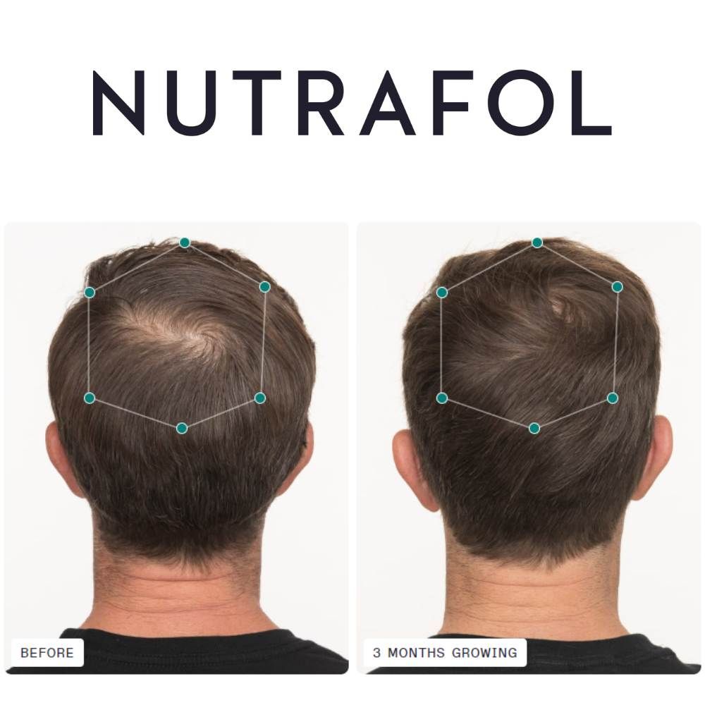 Nutrafol Men before and after 3 months growing