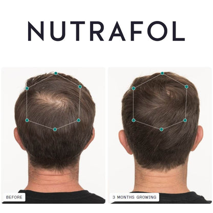 Nutrafol Men before and after 3 months growing